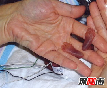 世界上最小的嬰兒之謎,你一定沒(méi)見(jiàn)過(guò)(僅重280克且存活下來(lái))