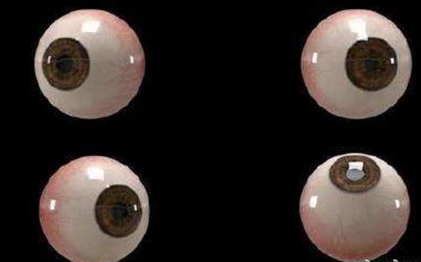 世界首個(gè)3D人工眼球問(wèn)世，數百萬(wàn)人將重見(jiàn)光明