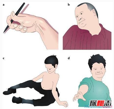中國世界首例舞蹈豬,亨廷頓氏舞蹈癥是什么??？